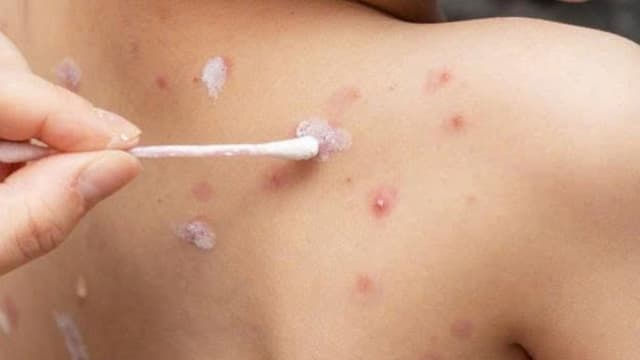 Nốt thuỷ đậu mới mọc: Dấu hiệu nhận biết và cách chăm sóc