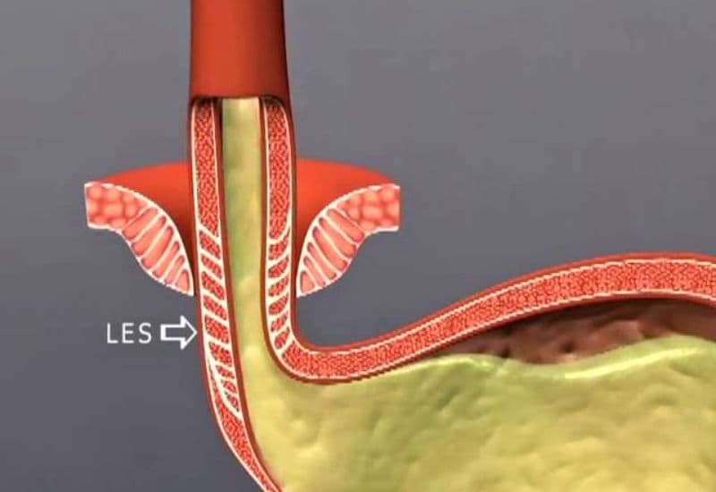 Nguyên nhân gây ợ chua và cách khắc phục