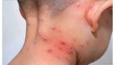 Triệu chứng bị thủy đậu: Dấu hiệu nhận biết và phòng ngừa