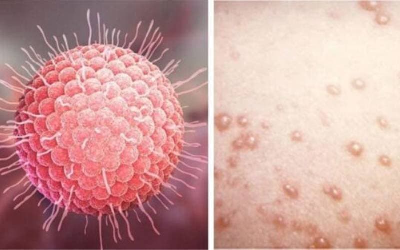 Triệu chứng bị thủy đậu dễ nhận biết 