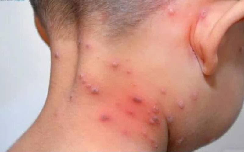 Triệu chứng bị thủy đậu nguy hiểm không