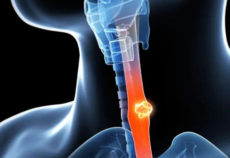 Nuốt đau ở thực quản có phải là dấu hiệu của ung thư