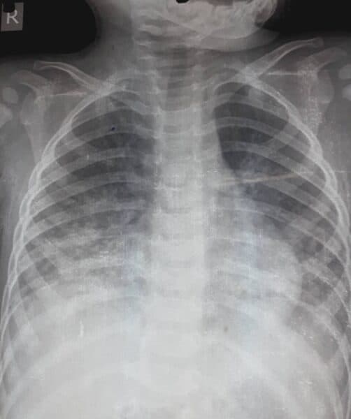 Viêm phổi là một trong những bệnh lý phổ biến và nguy hiểm đối với trẻ nhỏ. 