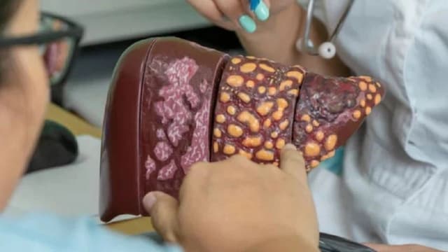 Những điều cần biết về bệnh gan nhiễm mỡ