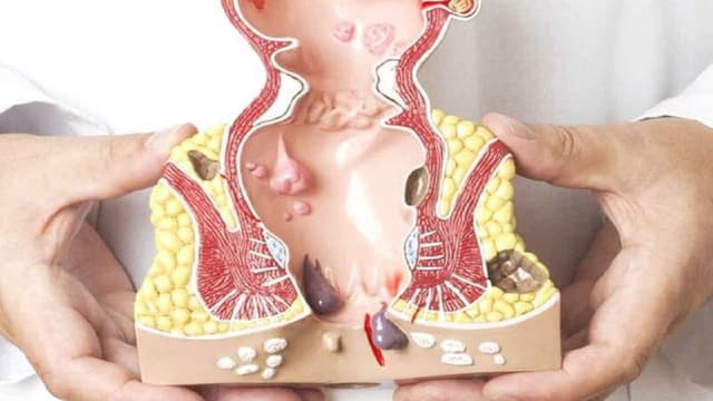 Tìm hiểu bệnh trĩ nội và các cấp độ trĩ nội
