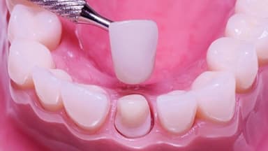 Bọc răng sứ chi phí thế nào – Tìm hiểu và cân nhắc hợp lý