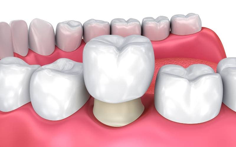 Bọc răng sứ chi phí đắt không