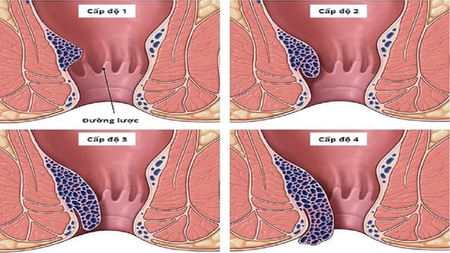 Trĩ nội cấp độ 3 đã cần can thiệp chưa?