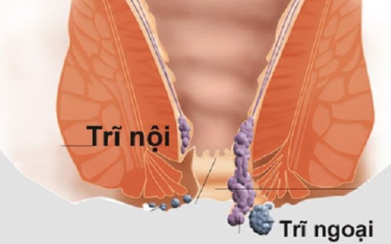 chữa khỏi bệnh trĩ