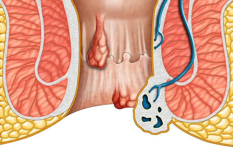 Hình ảnh các búi trĩ