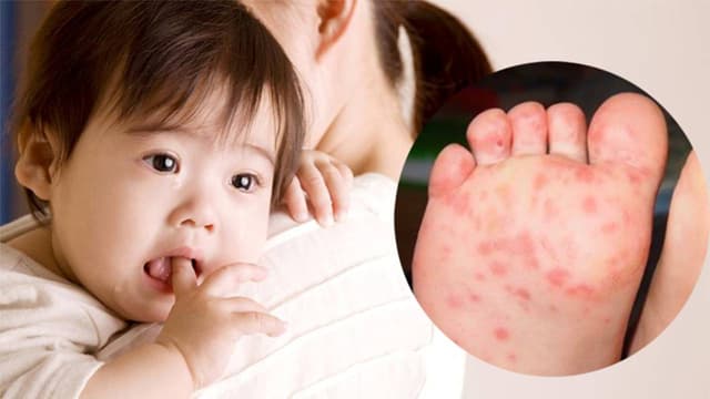 Dấu hiệu bị tay chân miệng ở trẻ em – Cha mẹ lưu ý