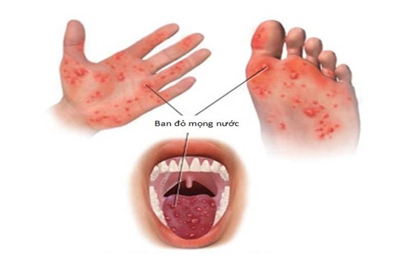 Các Dấu hiệu bị tay chân miệng ở trẻ em