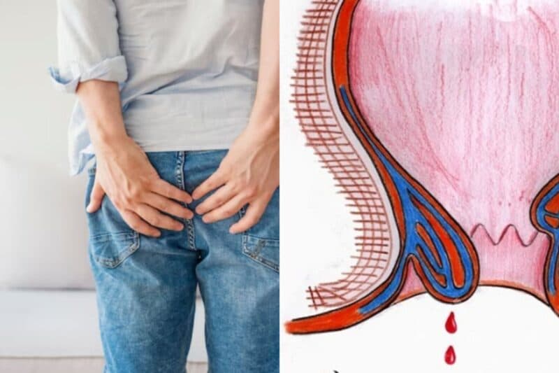 Ở giai đoạn 2 trở đi, người bệnh có thể nhận thấy búi trĩ sa ra ngoài hậu môn - Dấu hiệu của bệnh trĩ nội