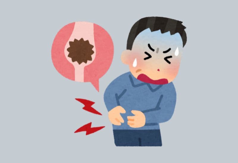 Dấu hiệu bị thận ứ nước do sỏi thận