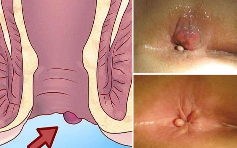 Bệnh nhân cần thăm khám chuyên khoa để được chẩn đoán cấp độ trĩ