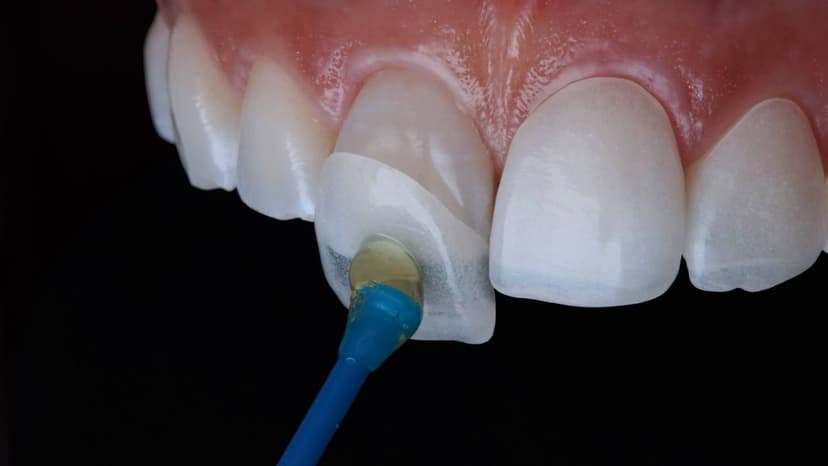 Giá dán Veneer – Những điều bạn nên chú ý