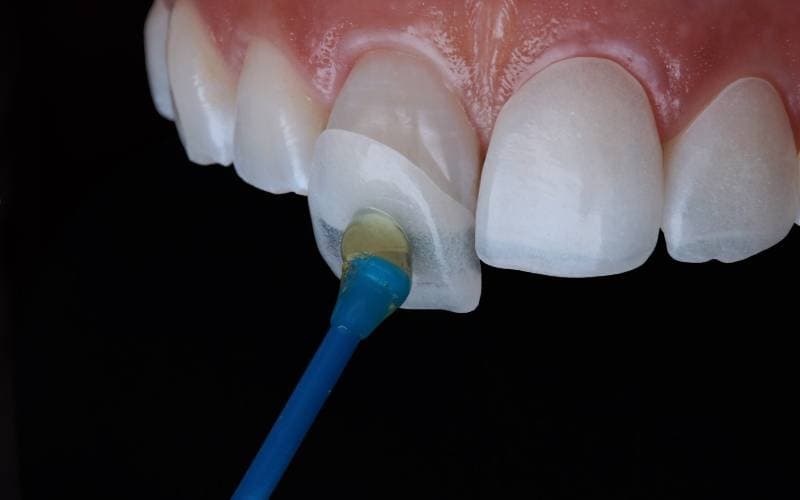 Giá dán Veneer rẻ