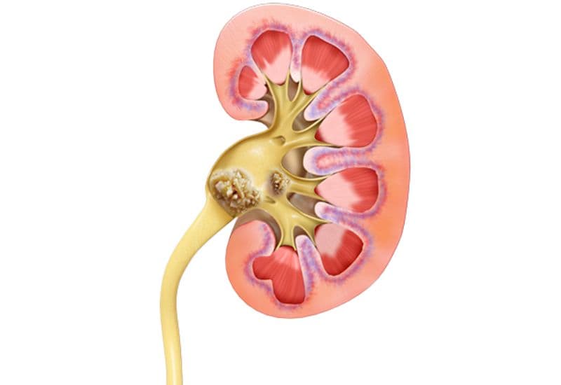 Giãn đài bể thận độ 3 là gì và có nguy hiểm không?