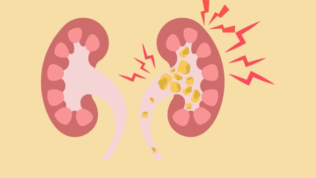 Giãn đài bể thận do sỏi: Tại sao bạn không nên chủ quan?