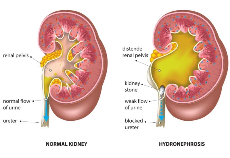 Phân độ giãn đài bể thận và cơ chế hình thành bệnh