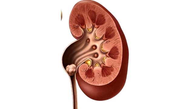 Giãn đài bể thận: Nguyên nhân, triệu chứng và cách phòng tránh