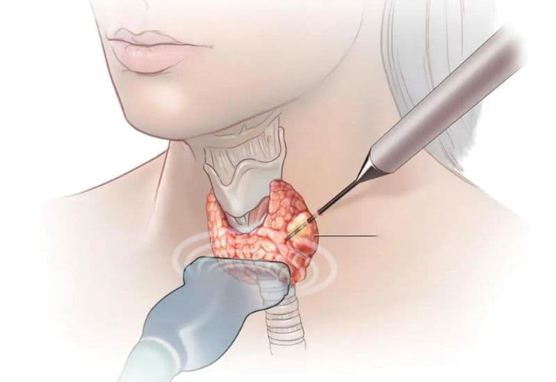Ưu điểm của phương pháp đốt sóng cao tần u lành tuyến giáp