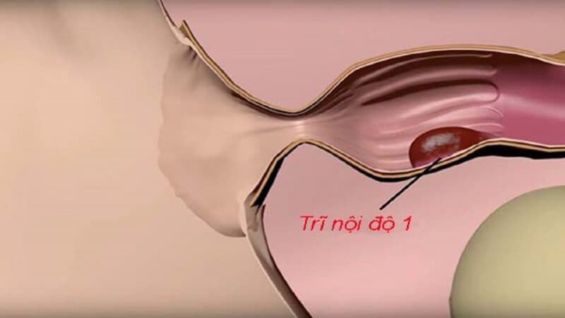 Trĩ nội độ 1 thường được điều trị bằng thuốc