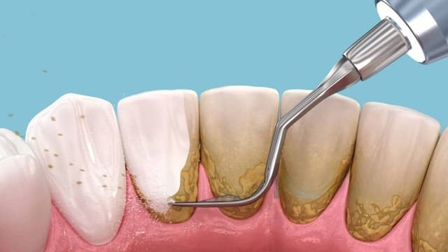 Lấy cao răng hết bao tiền – Tìm hiểu ngay