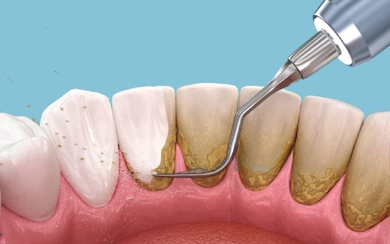 Lấy cao răng hết bao tiền tại phòng khám