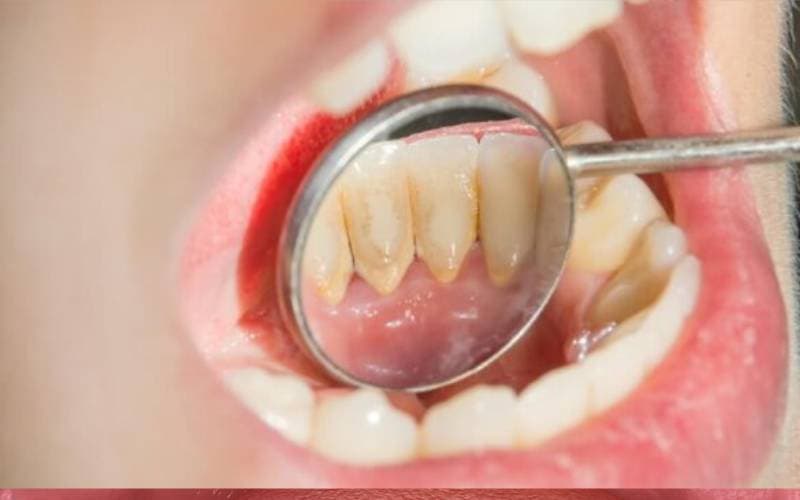 Lấy cao răng hết bao tiền tại Thu Cúc