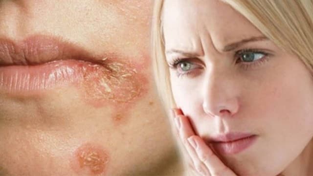 Nấm ở mép miệng – Nguyên nhân và giải pháp