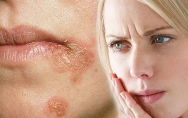 Nấm ở mép miệng vì đâu