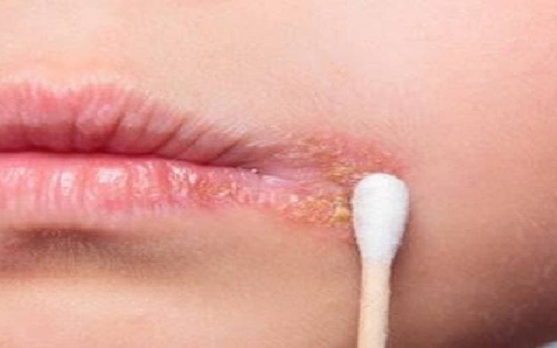 Nấm ở mép miệng chữa thế nào