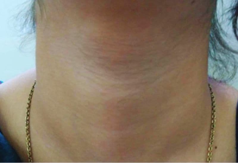 Nang tuyến giáp và triệu chứng là gì