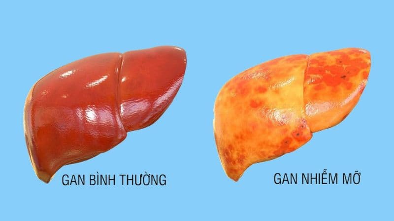 Nguyên nhân gây bệnh gan nhiễm mỡ là gì?