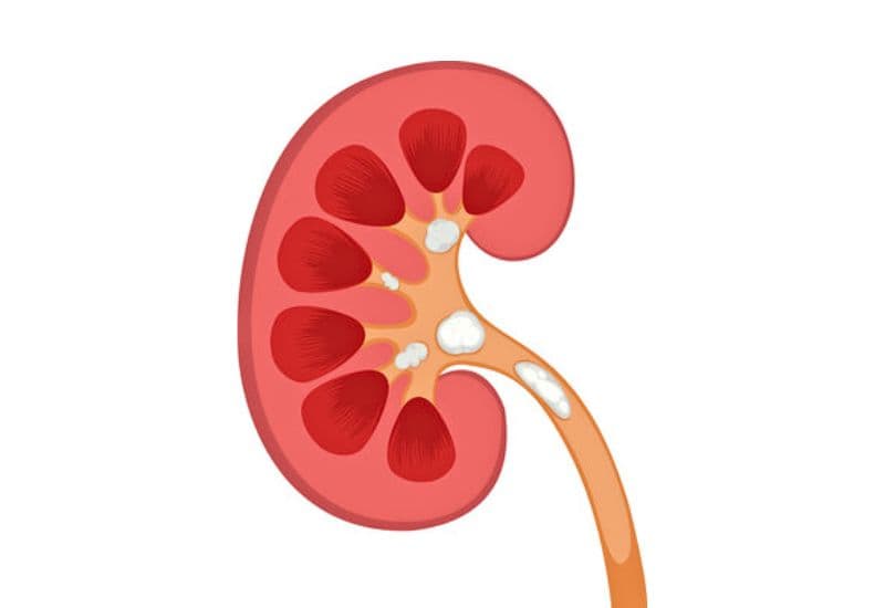 Nguyên nhân gây thận ứ nước và cơ chế hình thành bệnh