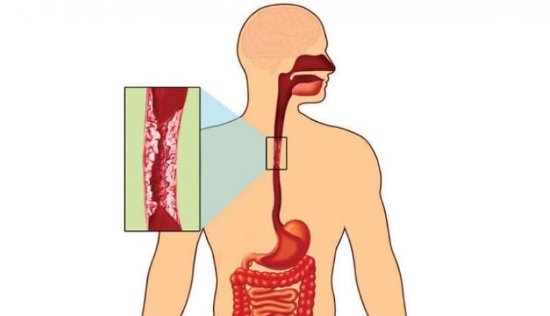 Ợ nóng đầy bụng tác động như thế nào đến cơ thể?