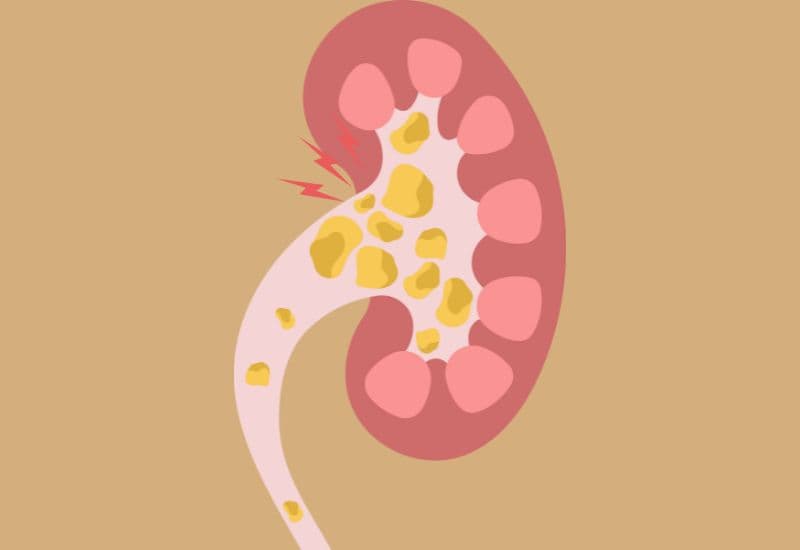 Nguyên nhân gây giãn đài bể thận là gì