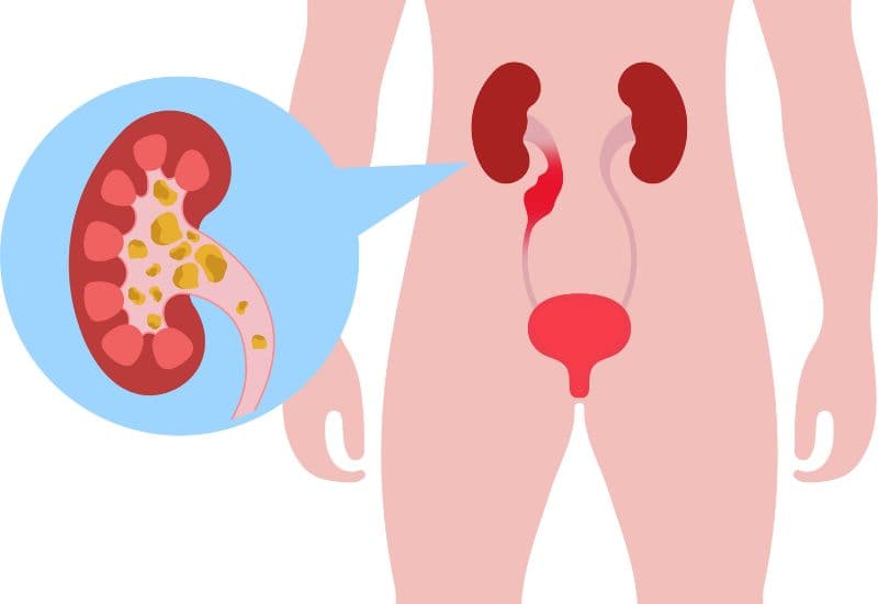 Cơ chế gây ứ nước thận do sỏi thận