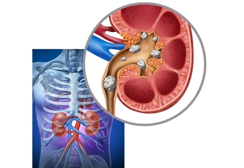 Các nguyên nhân gây giãn đài bể thận