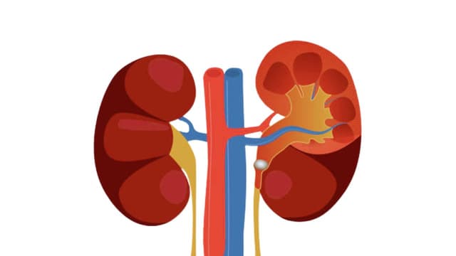 Sỏi thận gây ứ nước: Cơ chế và phân biệt từng giai đoạn