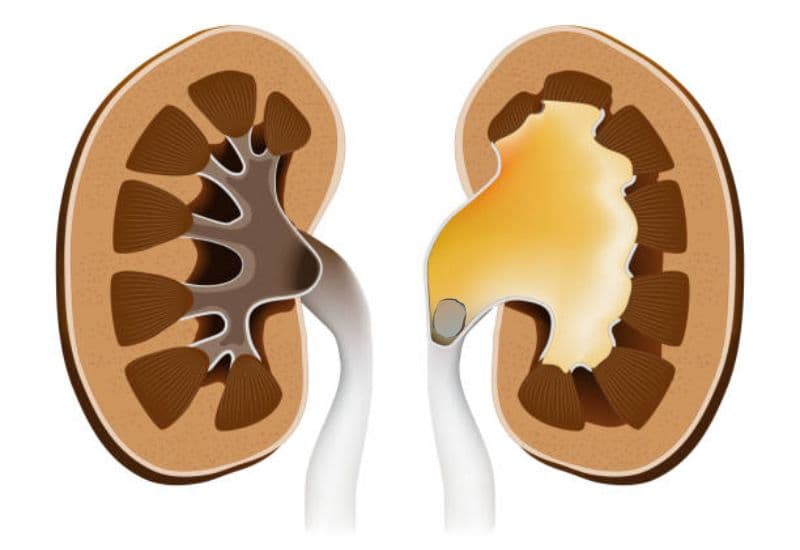 Tình trạng sỏi thận tắc nghẽn gây ứ nước