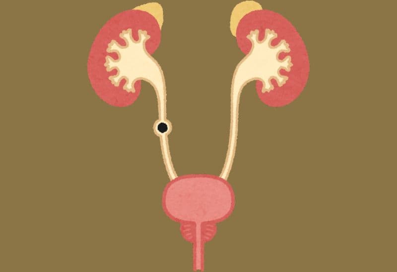 Mối liên hệ giữa thận ứ nước và sỏi thận