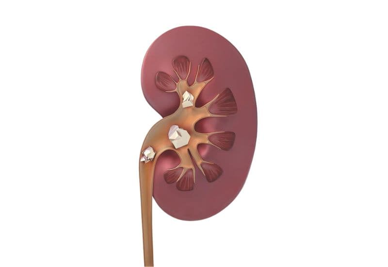 Thận ứ nước do sỏi niệu quản hình thành như thế nào?