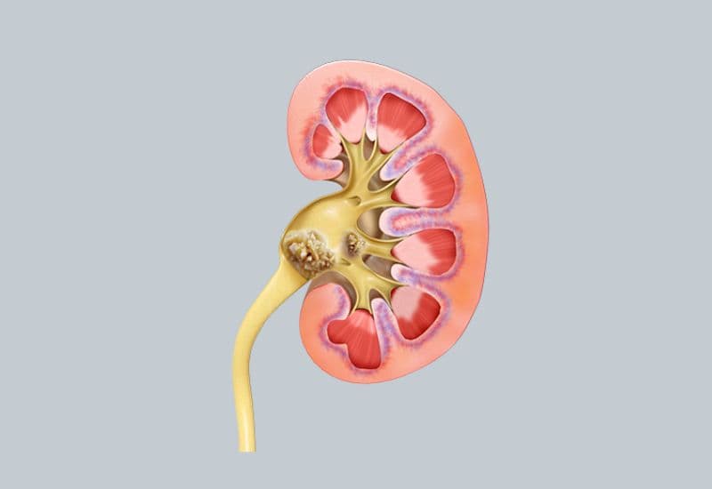 Nguyên nhân gây thận ứ nước do sỏi thận