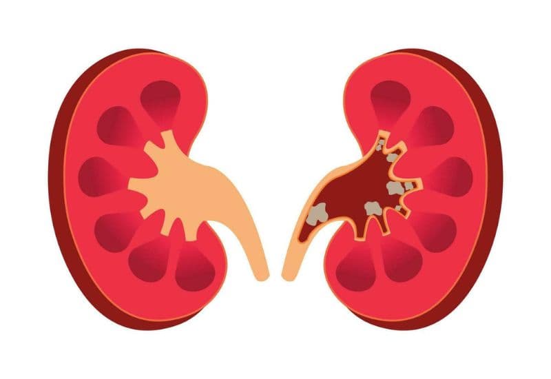 Phân biệt từng giai đoạn của sỏi thận gây ứ nước