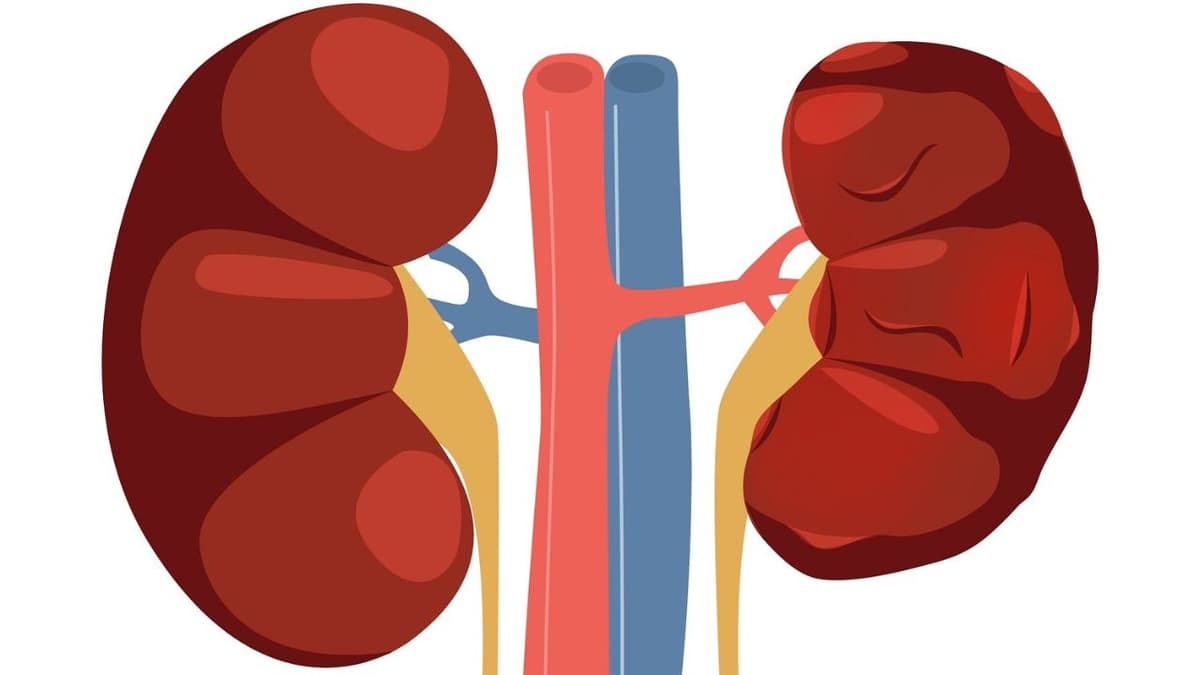 Thận ứ nước độ 4 là gì? Nguyên nhân và cách điều trị hiệu quả