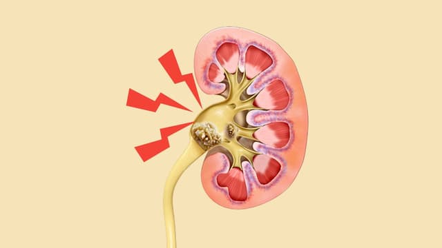 Thận ứ nước do sỏi và mối liên hệ với suy thận