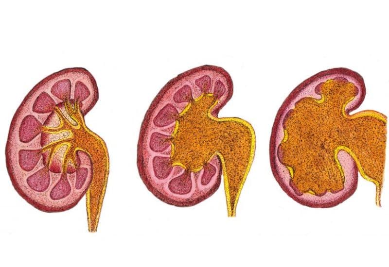 Thận ứ nước là gì?