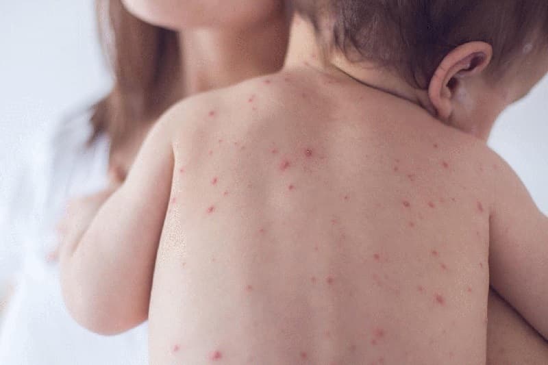 Sởi, quai bị và rubella là ba bệnh truyền nhiễm gây ra nhiều biến chứng nguy hiểm.